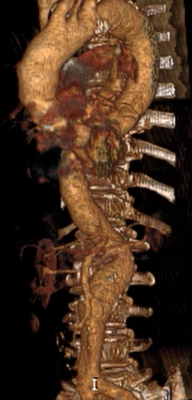 IMAGINE ANGIOCT -CAZUISTICA DR. ARAMESCU: ANEVRISM DE AORTA ABDOMINALA CU DEZVOLTARE EXCENTRICA TROMBOZA PARIETALA ANTERIOARA DREAPTA